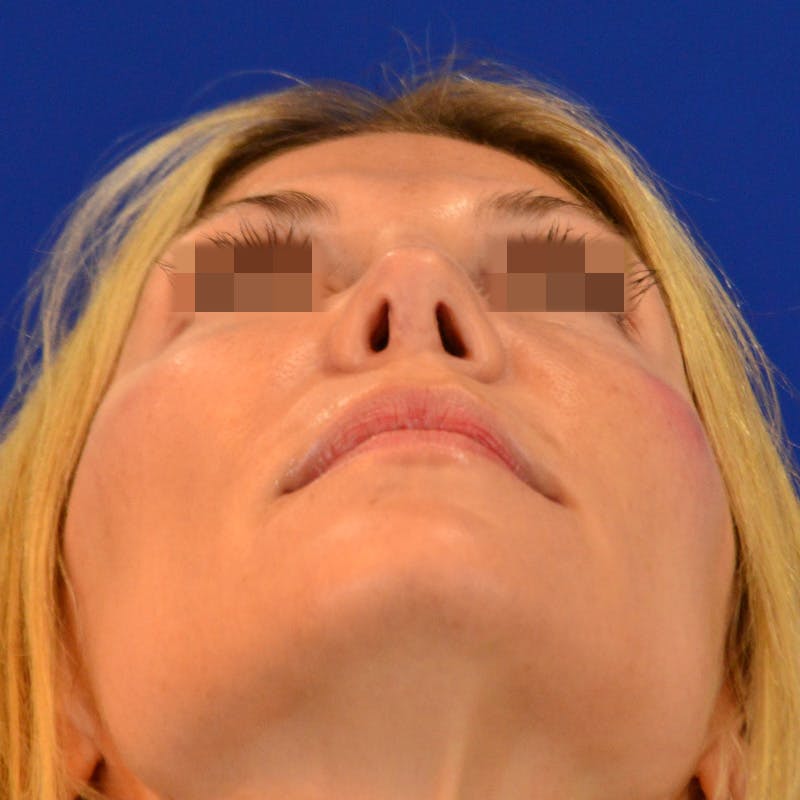 Revision Rhinoplasty Before & After Gallery - Patient 271439 - Image 16