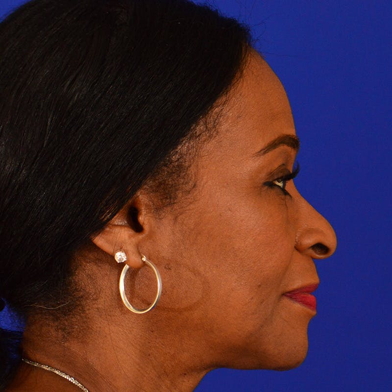 Ethnic Rhinoplasty Before & After Gallery - Patient 224426 - Image 1