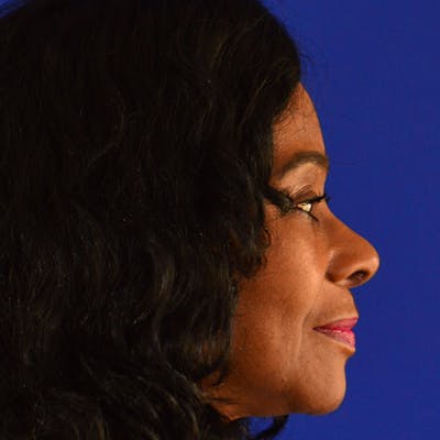 Ethnic Rhinoplasty Before & After Gallery - Patient 224426 - Image 2