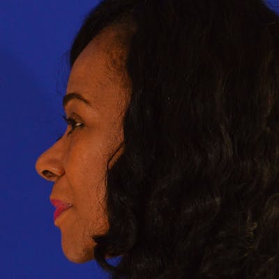 Female Rhinoplasty Before & After Gallery - Patient 799931 - Image 2