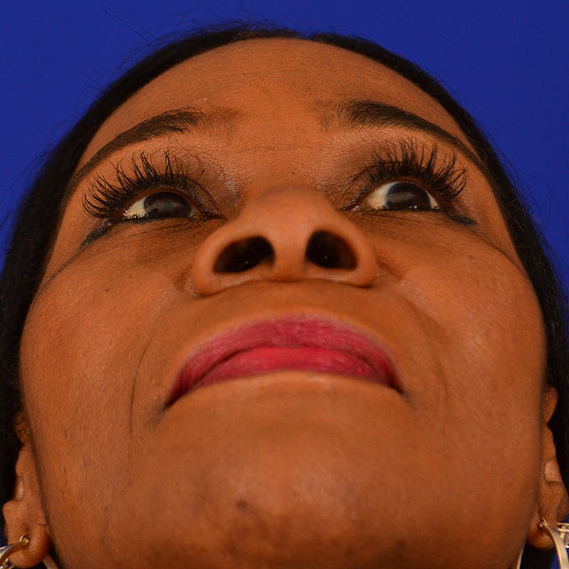Ethnic Rhinoplasty Before & After Gallery - Patient 224426 - Image 11