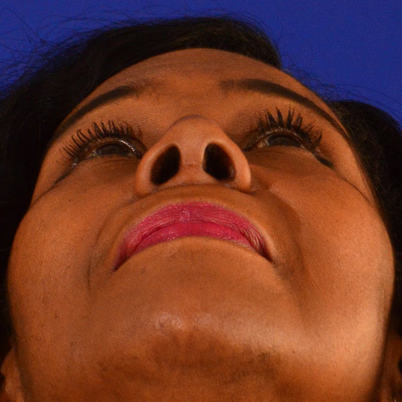 Ethnic Rhinoplasty Before & After Gallery - Patient 224426 - Image 12