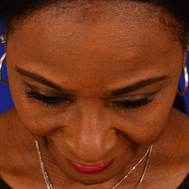 Ethnic Rhinoplasty Before & After Gallery - Patient 224426 - Image 13