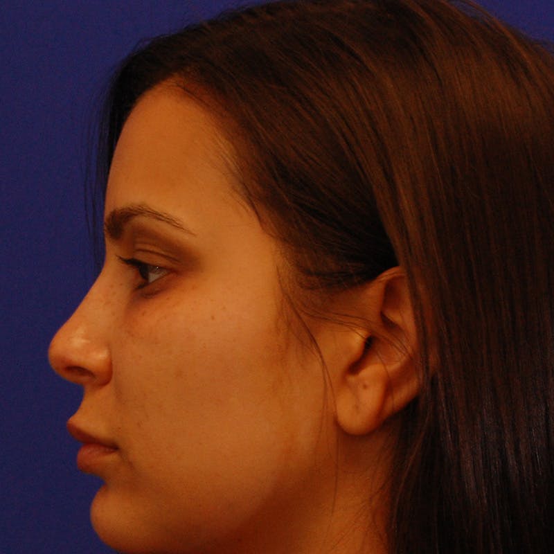 Female Rhinoplasty Before & After Gallery - Patient 290243 - Image 2