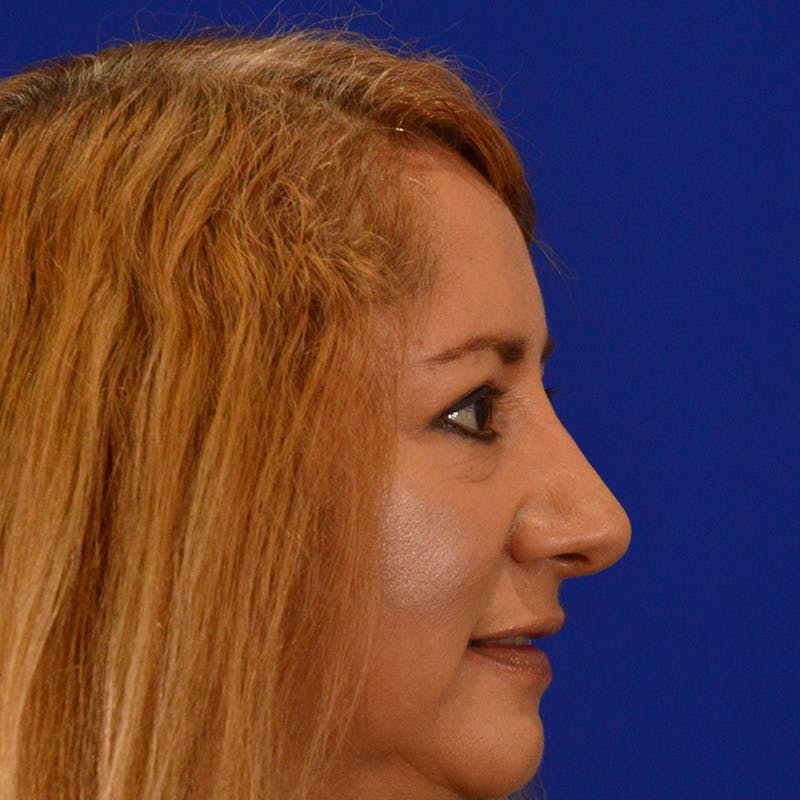 Brow Lift Before & After Gallery - Patient 426050 - Image 4