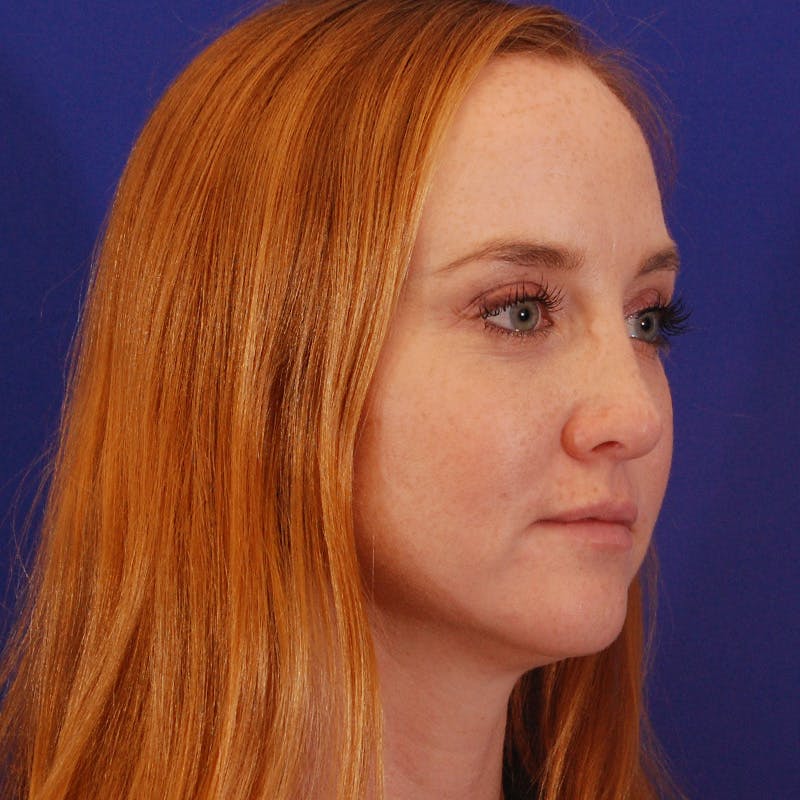 Revision Rhinoplasty Before & After Gallery - Patient 102457 - Image 6