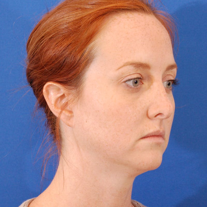 Revision Rhinoplasty Before & After Gallery - Patient 102457 - Image 5