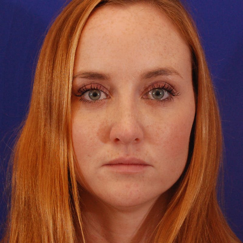 Revision Rhinoplasty Before & After Gallery - Patient 102457 - Image 8