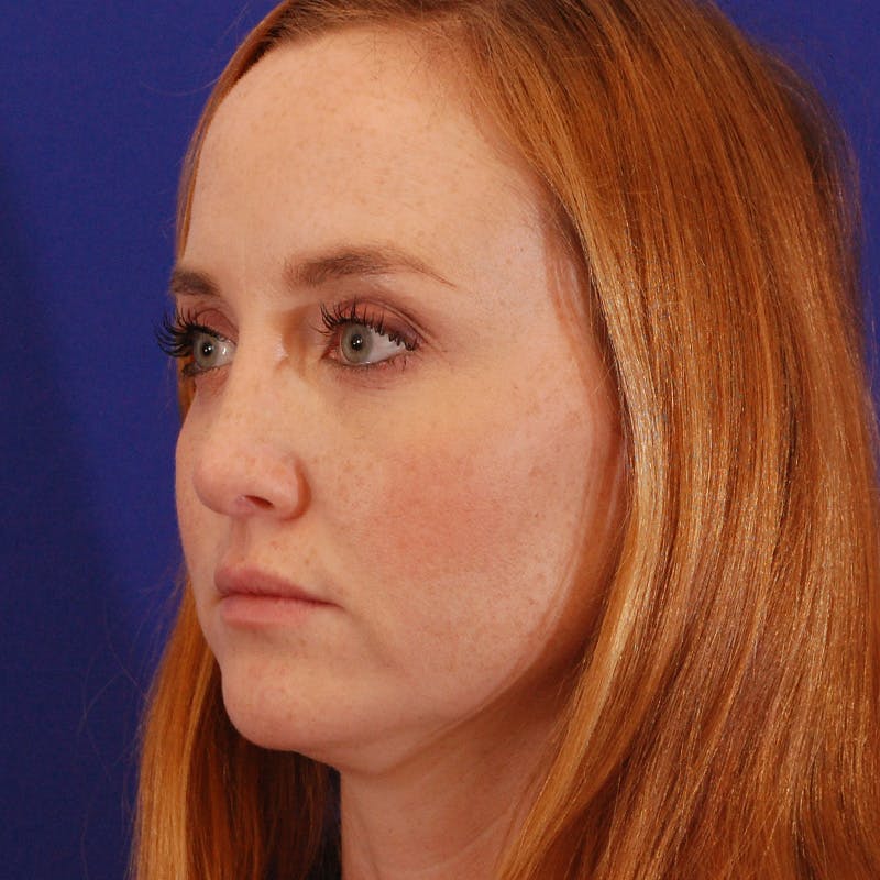 Revision Rhinoplasty Before & After Gallery - Patient 102457 - Image 10