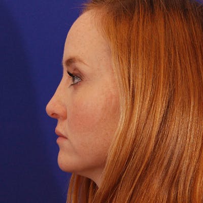 Revision Rhinoplasty Before & After Gallery - Patient 102457 - Image 2