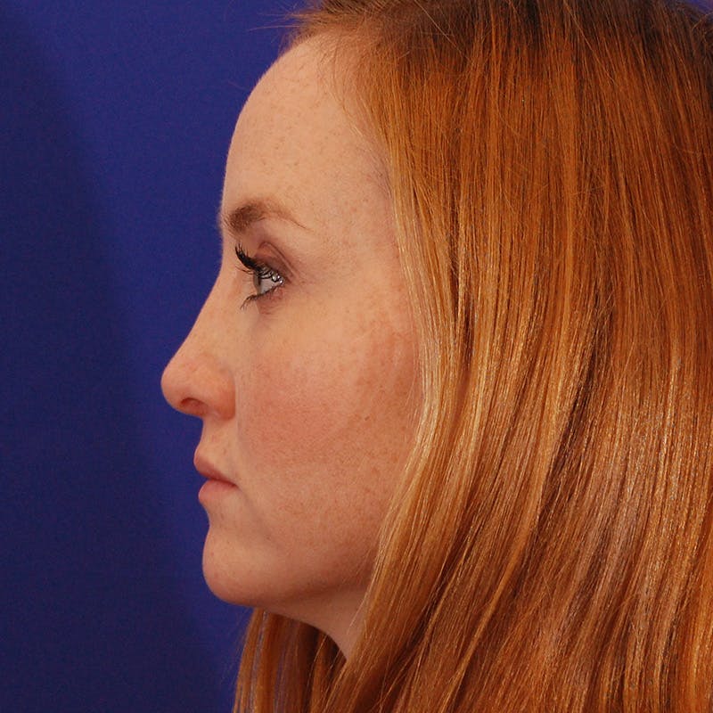 Revision Rhinoplasty Before & After Gallery - Patient 102457 - Image 2