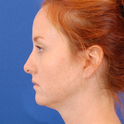 Revision Rhinoplasty Before & After Gallery - Patient 102457 - Image 1