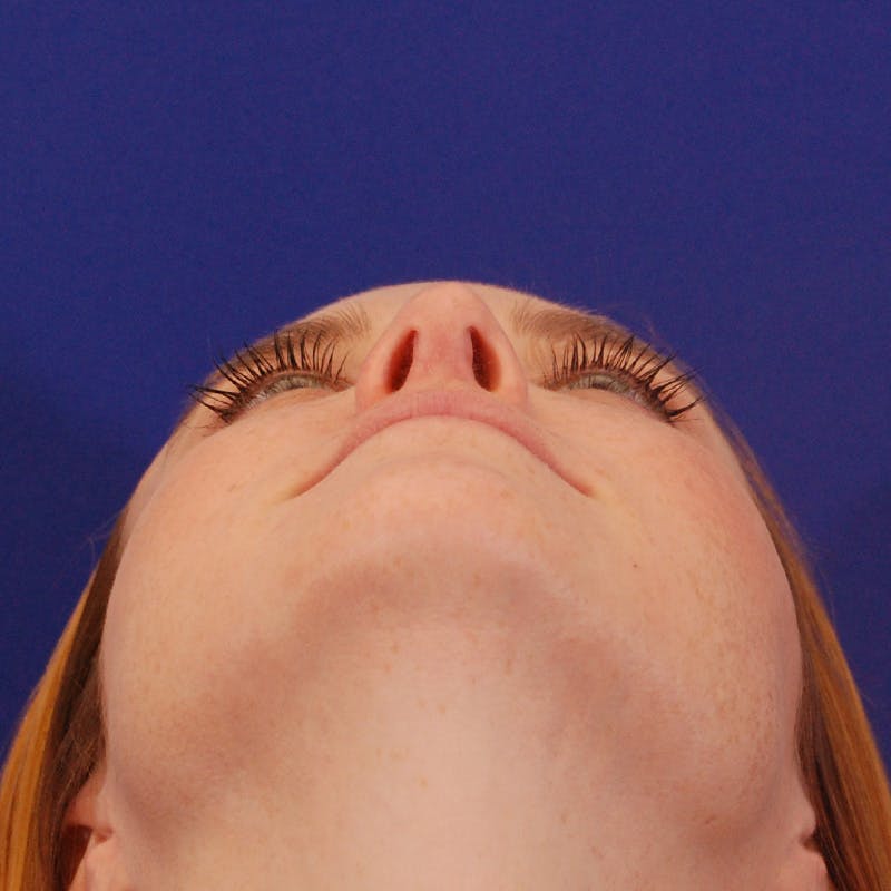 Revision Rhinoplasty Before & After Gallery - Patient 102457 - Image 12