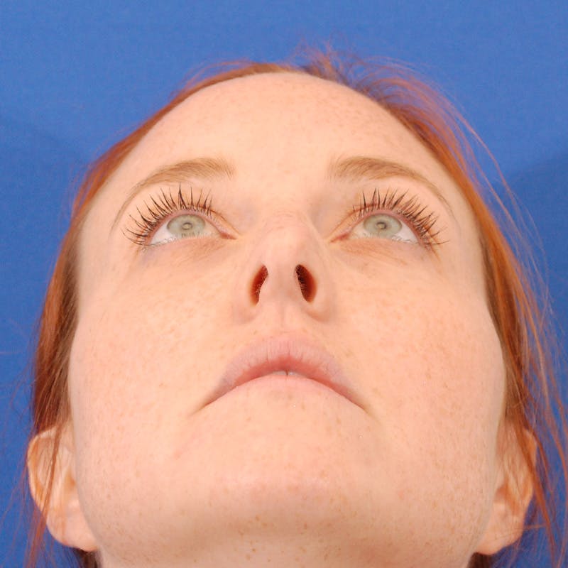 Revision Rhinoplasty Before & After Gallery - Patient 102457 - Image 11