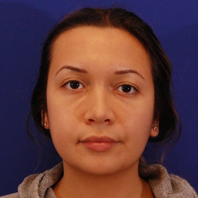 Wide Nose Before & After Gallery - Patient 612694 - Image 1