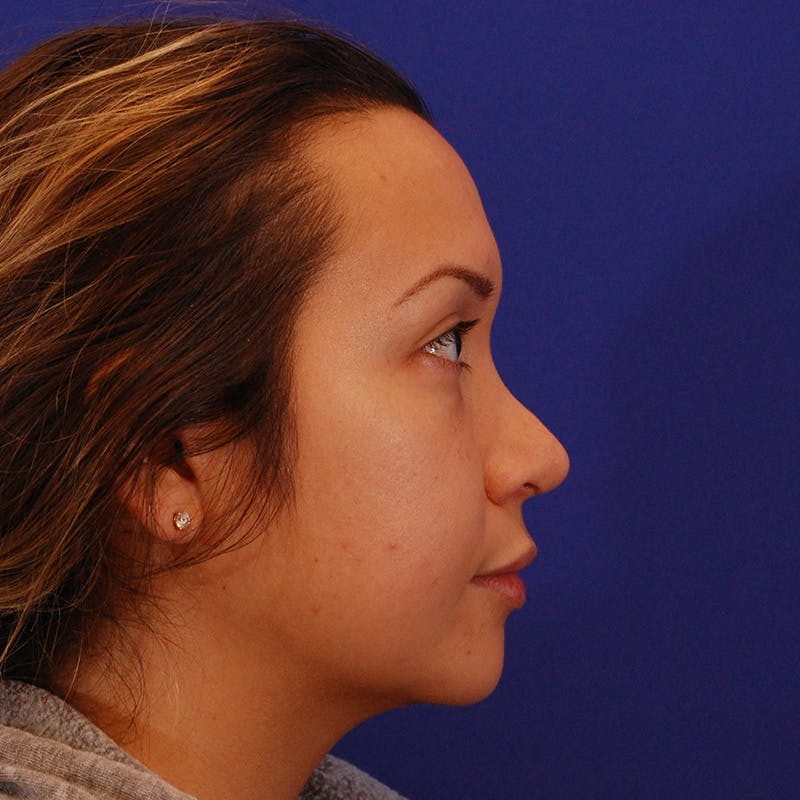 Revision Rhinoplasty Before & After Gallery - Patient 246325 - Image 1