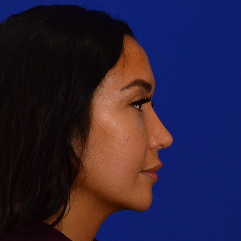 Revision Rhinoplasty Before & After Gallery - Patient 246325 - Image 2