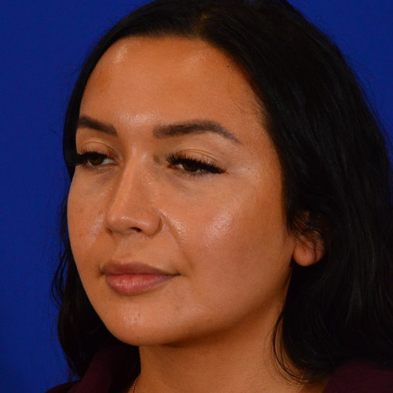 Revision Rhinoplasty Before & After Gallery - Patient 246325 - Image 8