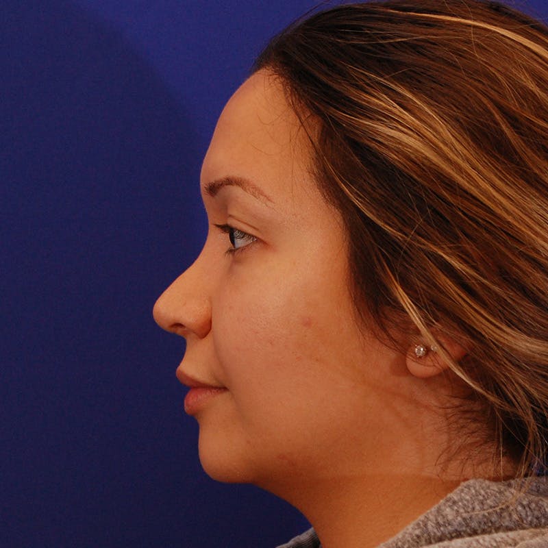 Revision Rhinoplasty Before & After Gallery - Patient 246325 - Image 9