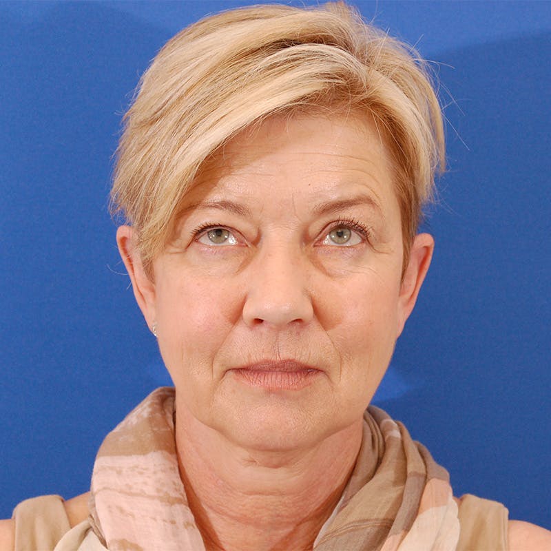 Facelift & Necklift Before & After Gallery - Patient 374284 - Image 1