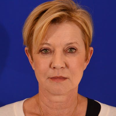 Facelift & Necklift Before & After Gallery - Patient 374284 - Image 2