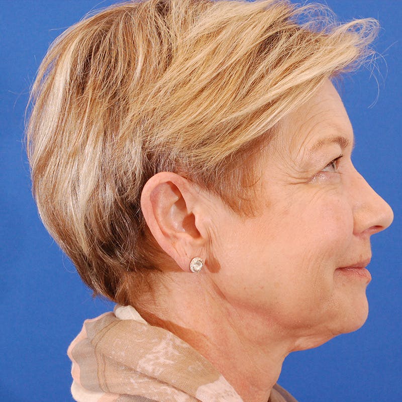 Facelift & Necklift Before & After Gallery - Patient 374284 - Image 5