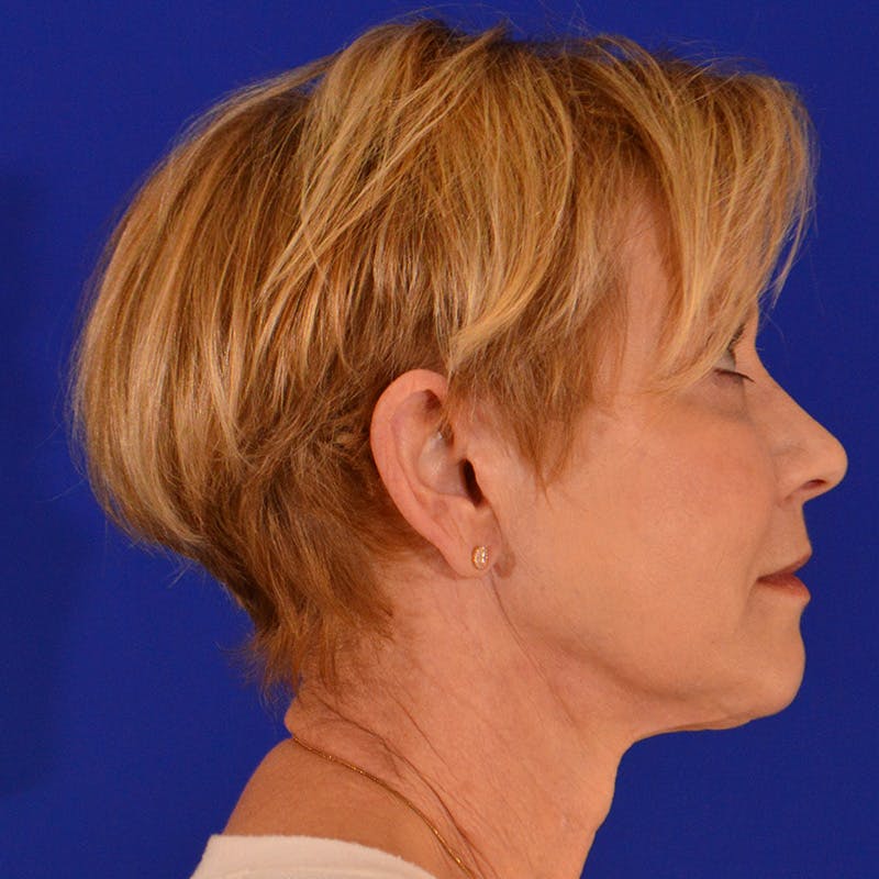 Facelift & Necklift Before & After Gallery - Patient 374284 - Image 6