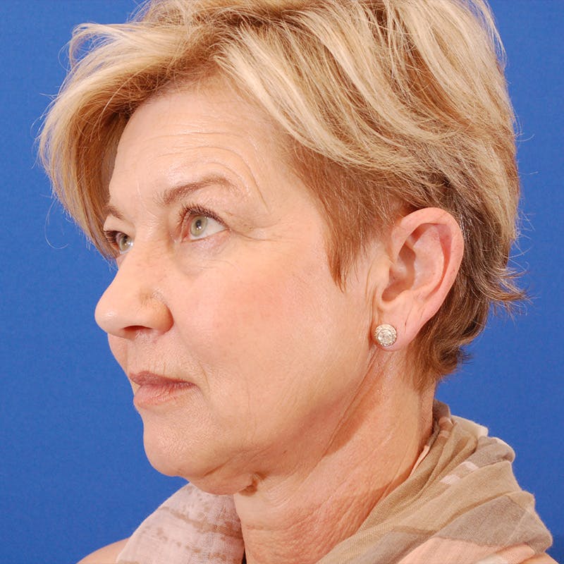 Facelift & Necklift Before & After Gallery - Patient 374284 - Image 7