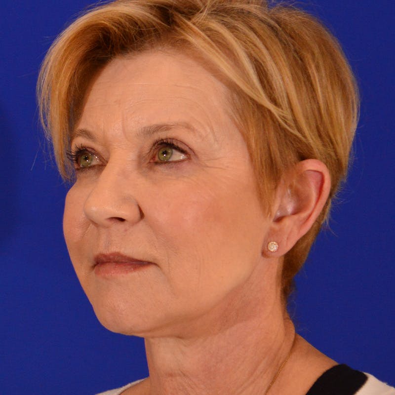 Facelift & Necklift Before & After Gallery - Patient 374284 - Image 8