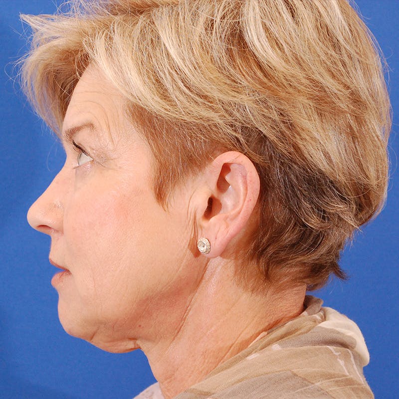 Facelift & Necklift Before & After Gallery - Patient 374284 - Image 9