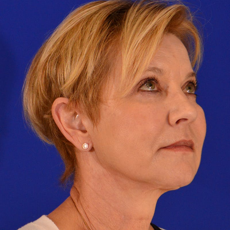 Facelift & Necklift Before & After Gallery - Patient 374284 - Image 4