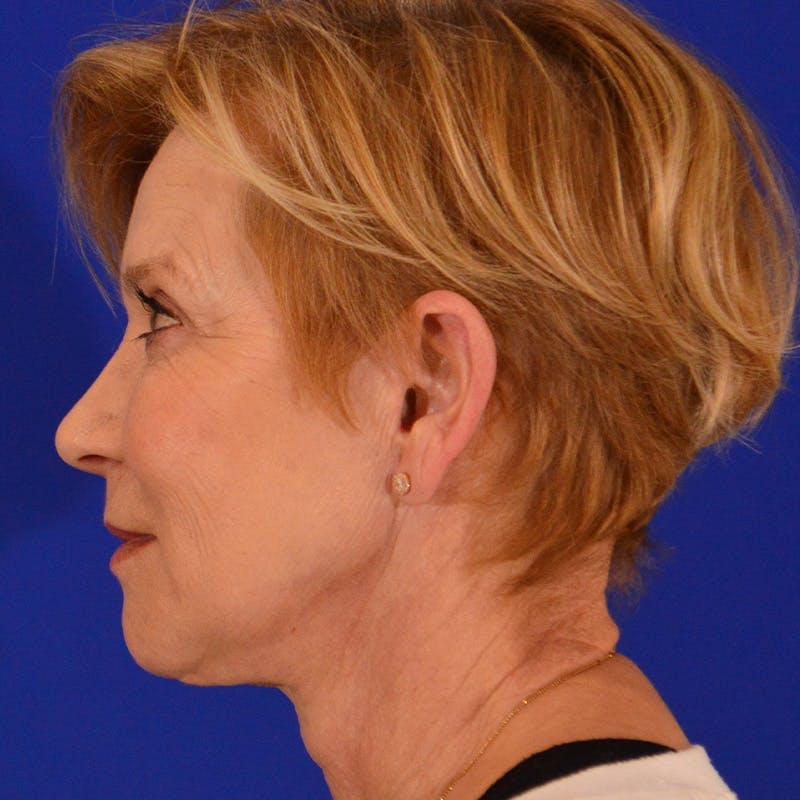 Facelift & Necklift Before & After Gallery - Patient 374284 - Image 10
