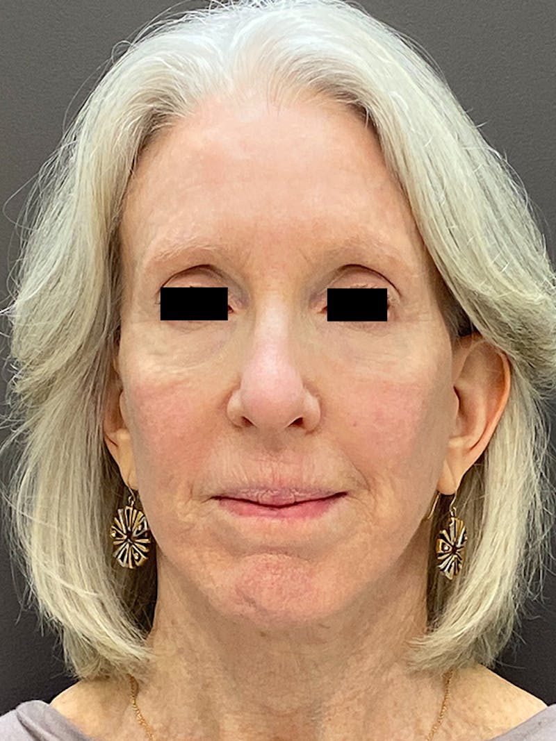 Facelift & Necklift Before & After Gallery - Patient 675221 - Image 2