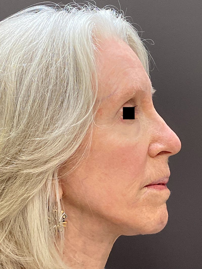 Facelift & Necklift Before & After Gallery - Patient 675221 - Image 6