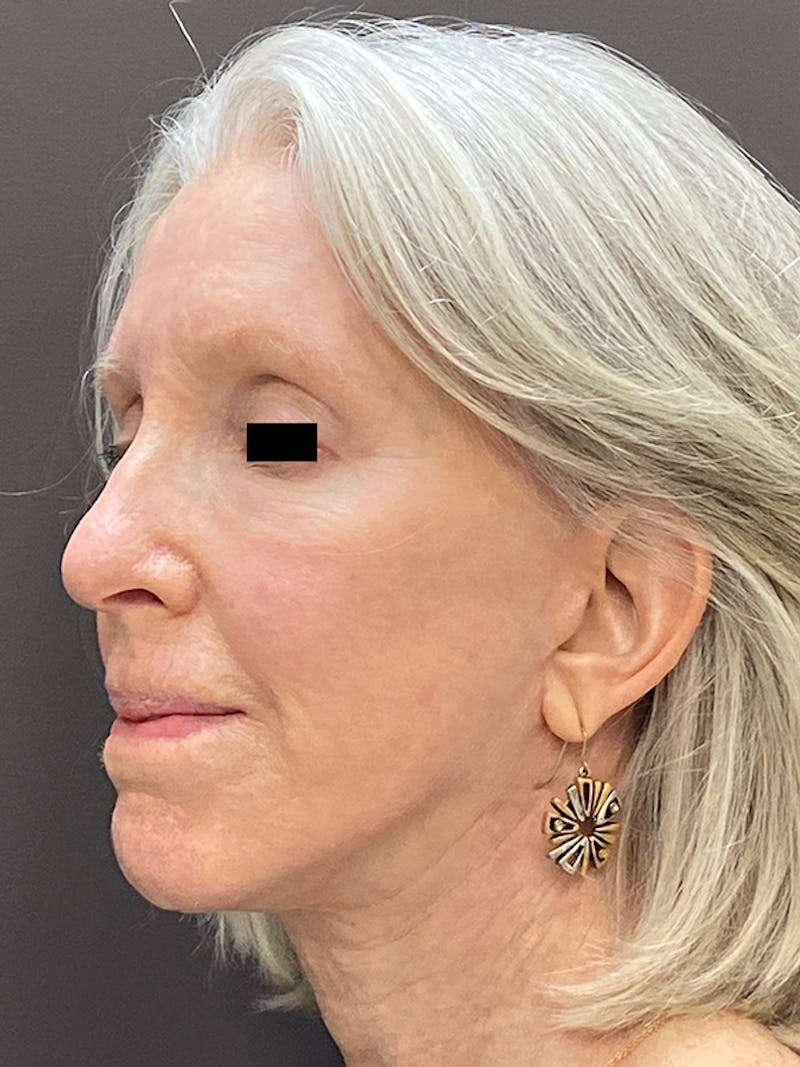 Facelift & Necklift Before & After Gallery - Patient 675221 - Image 8