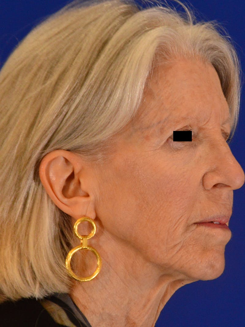 Facelift & Necklift Before & After Gallery - Patient 675221 - Image 3