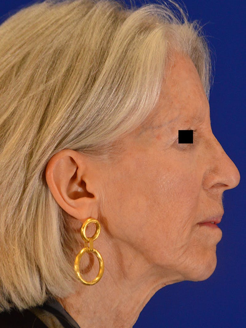 Facelift & Necklift Before & After Gallery - Patient 675221 - Image 5