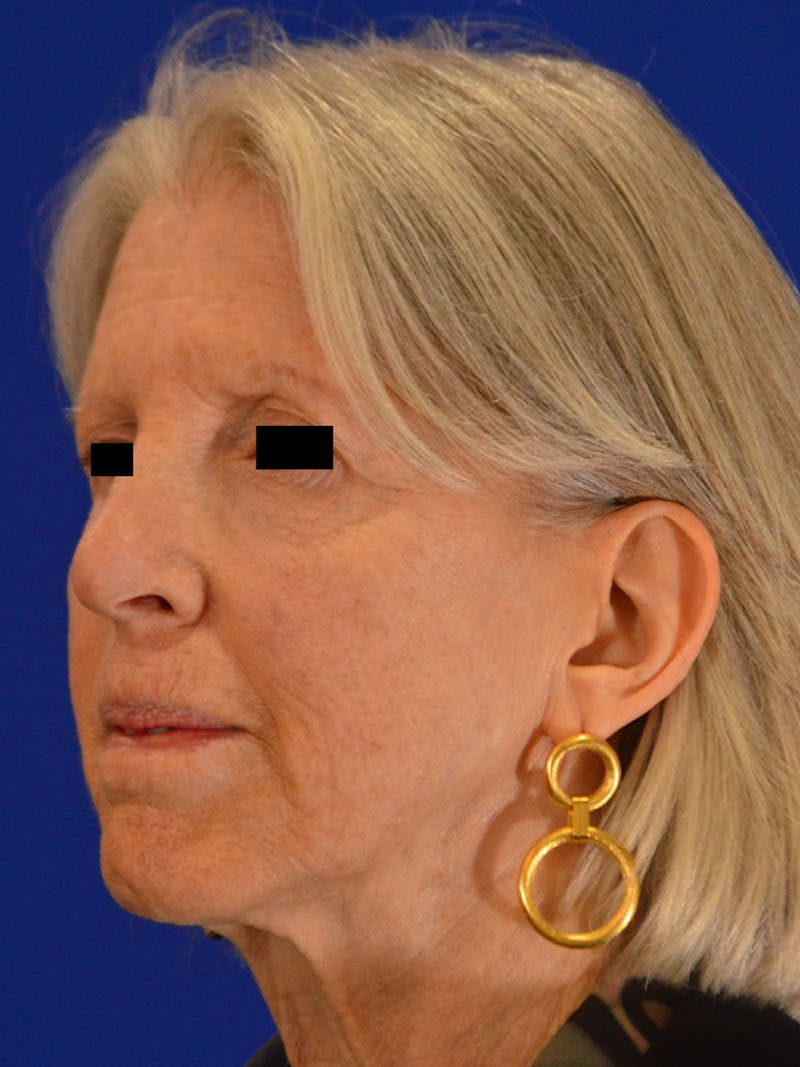 Facelift & Necklift Before & After Gallery - Patient 675221 - Image 7
