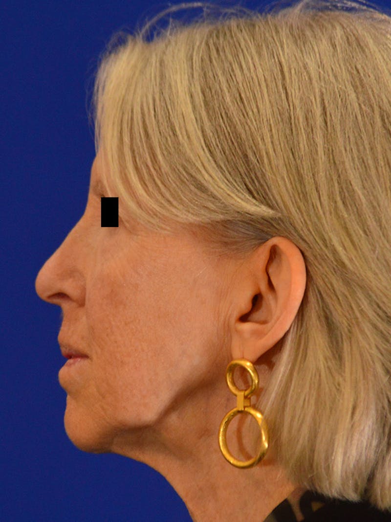 Facelift & Necklift Before & After Gallery - Patient 675221 - Image 9