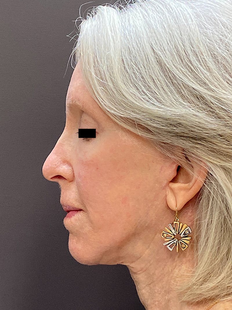 Facelift & Necklift Before & After Gallery - Patient 675221 - Image 10