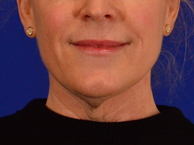Facelift & Necklift Before & After Gallery - Patient 255040 - Image 1