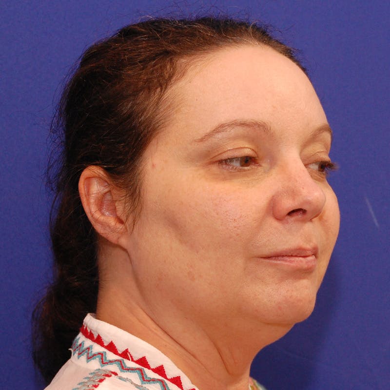 Facelift & Necklift Before & After Gallery - Patient 559526 - Image 3