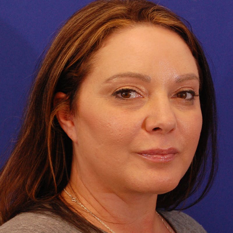 Facelift & Necklift Before & After Gallery - Patient 559526 - Image 4
