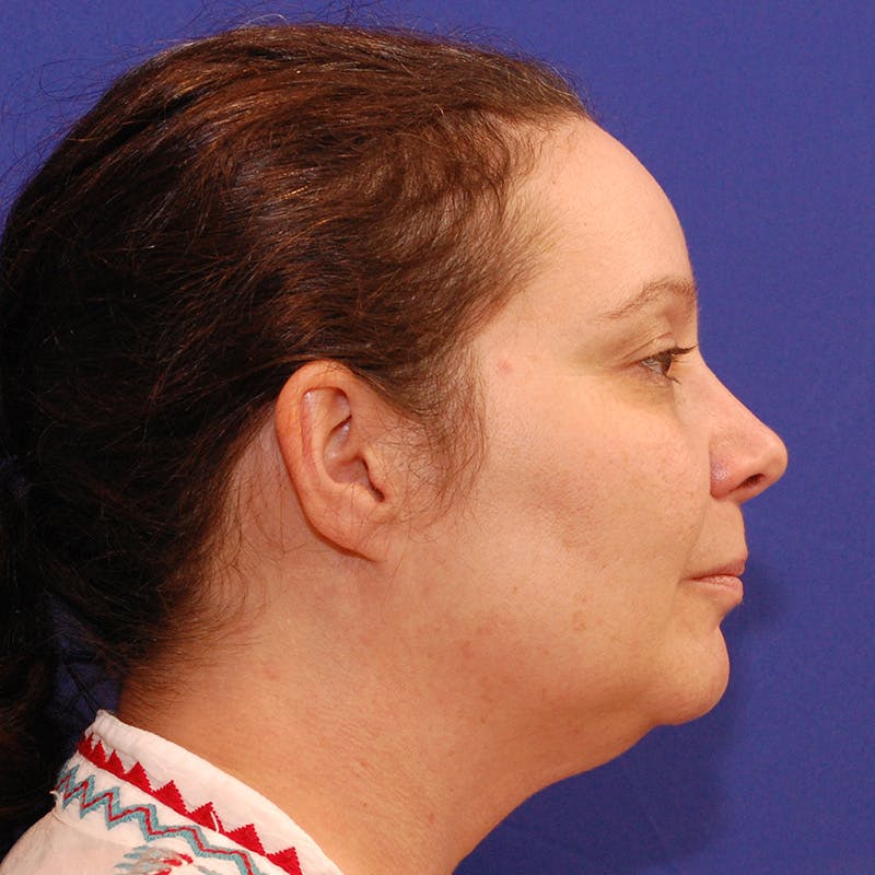 Facelift & Necklift Before & After Gallery - Patient 559526 - Image 5