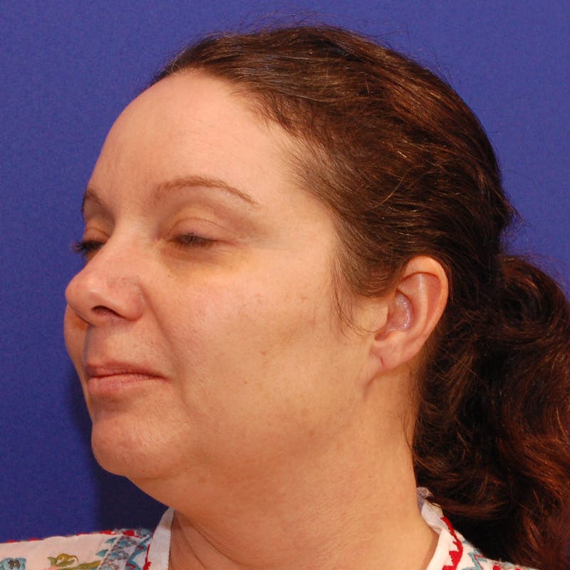 Facelift & Necklift Before & After Gallery - Patient 559526 - Image 7