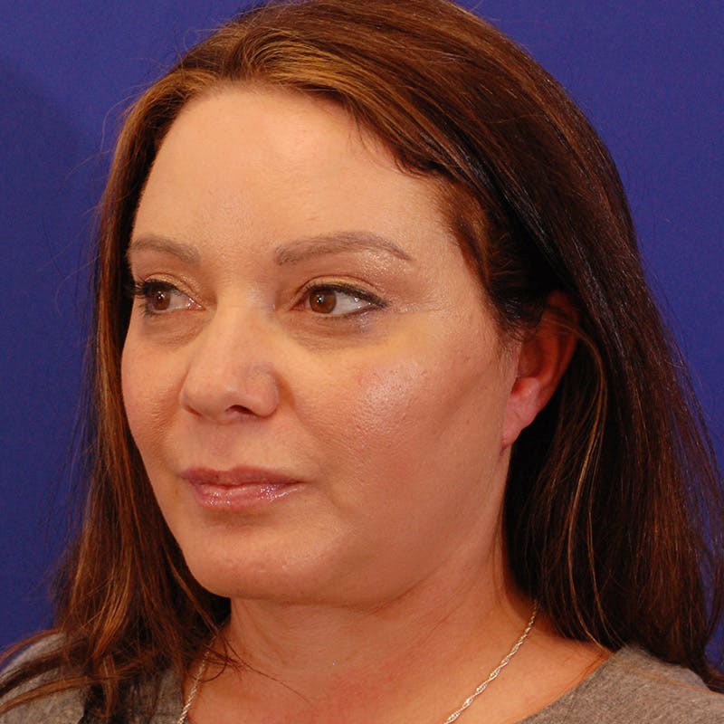 Facelift & Necklift Before & After Gallery - Patient 559526 - Image 8