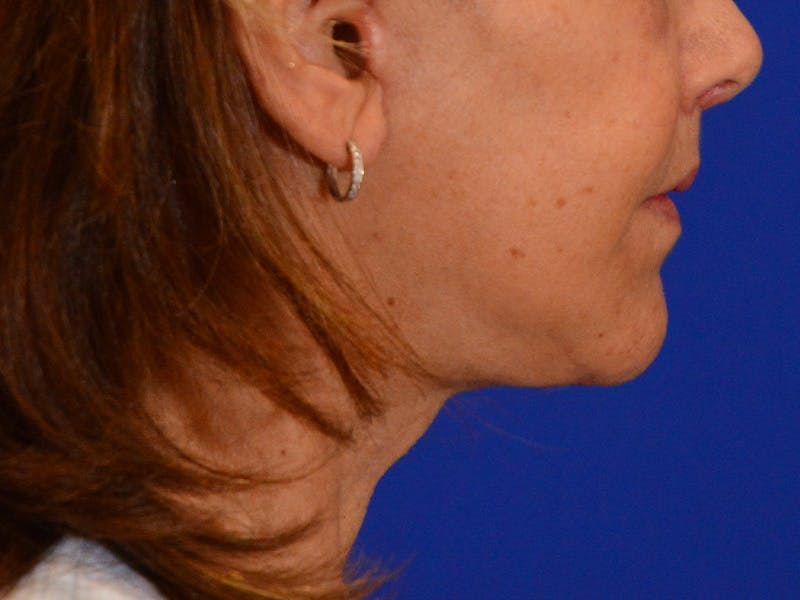 Facelift & Necklift Before & After Gallery - Patient 373957 - Image 6