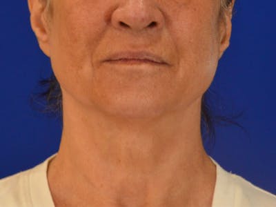 Facelift & Necklift Before & After Gallery - Patient 156087 - Image 1