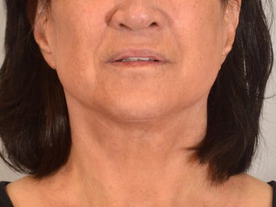 Facelift & Necklift Before & After Gallery - Patient 156087 - Image 2