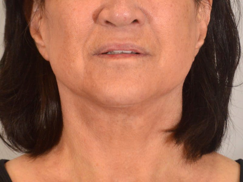 Facelift & Necklift Before & After Gallery - Patient 156087 - Image 2